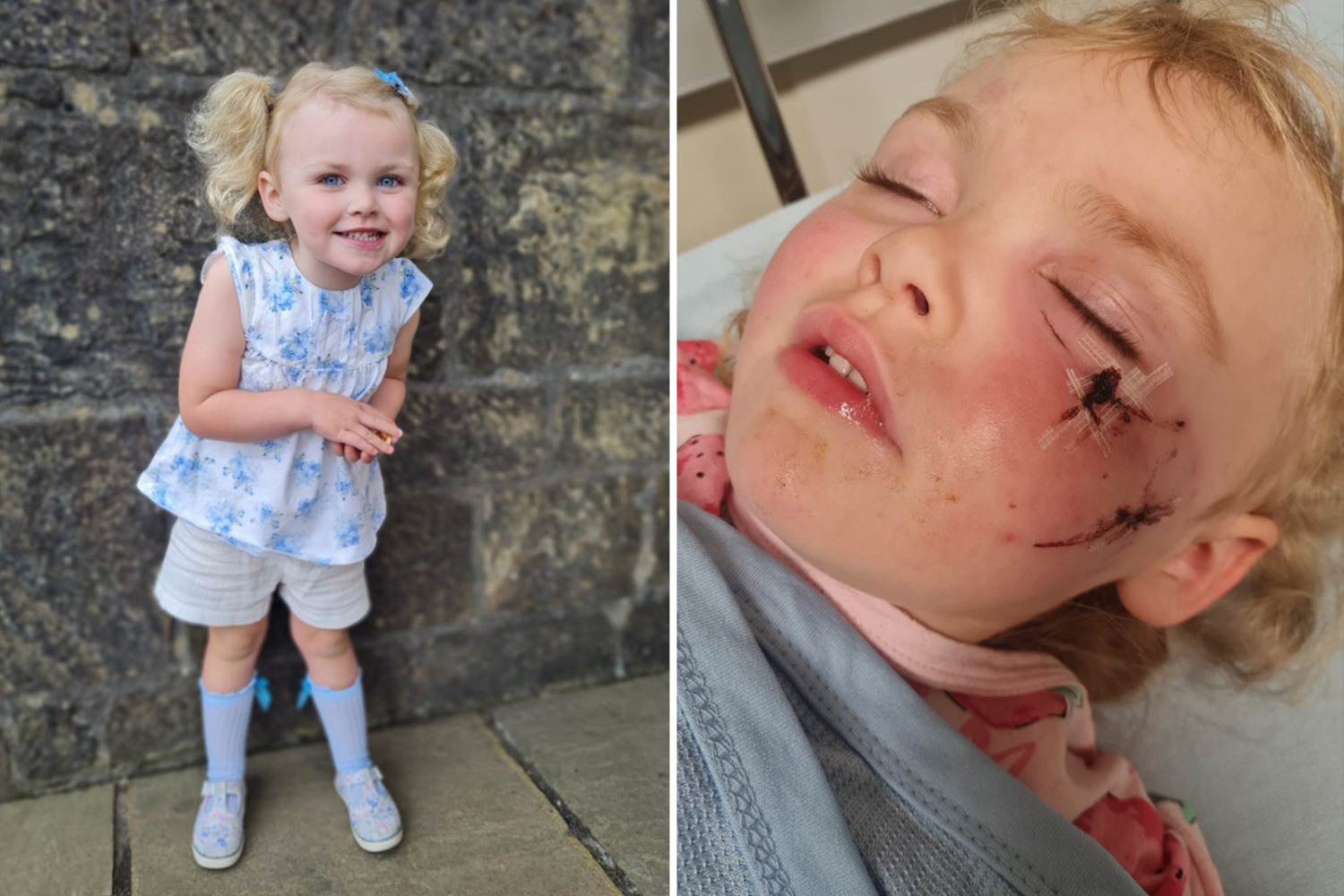 My daughter, 3, needs plastic surgery after a dog savaged her face - she's afraid to leave the house RM-dog-attack-comp.jpg