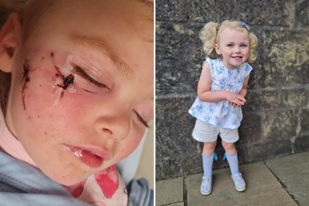My daughter, 3, needs plastic surgery after a dog savaged her face girl-mauled-face-dog-surgery-99.jpg
